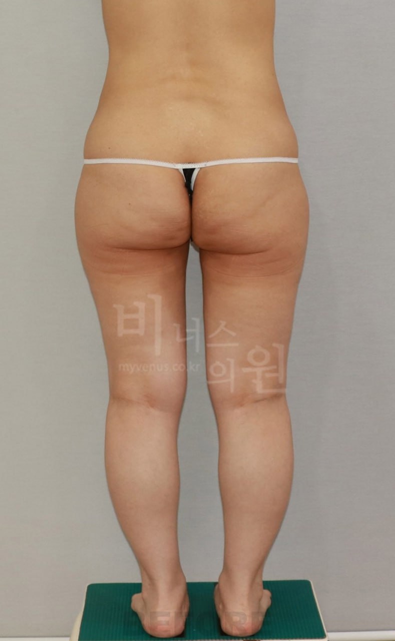 엉덩이 지방흡입 수술 전 후면 비너스의원