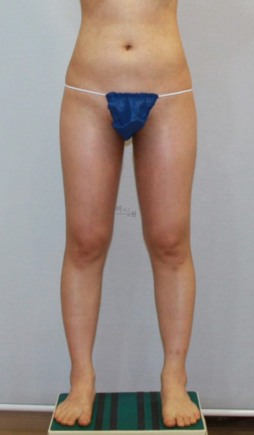 허벅지지방흡입6.jpg