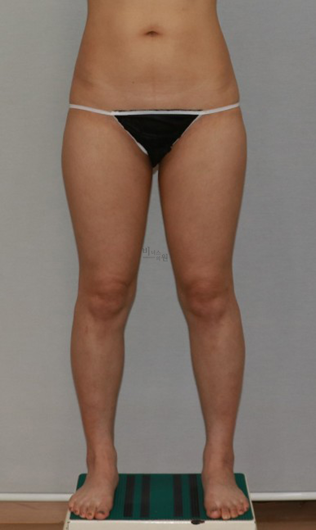 허벅지지방흡입17.jpg