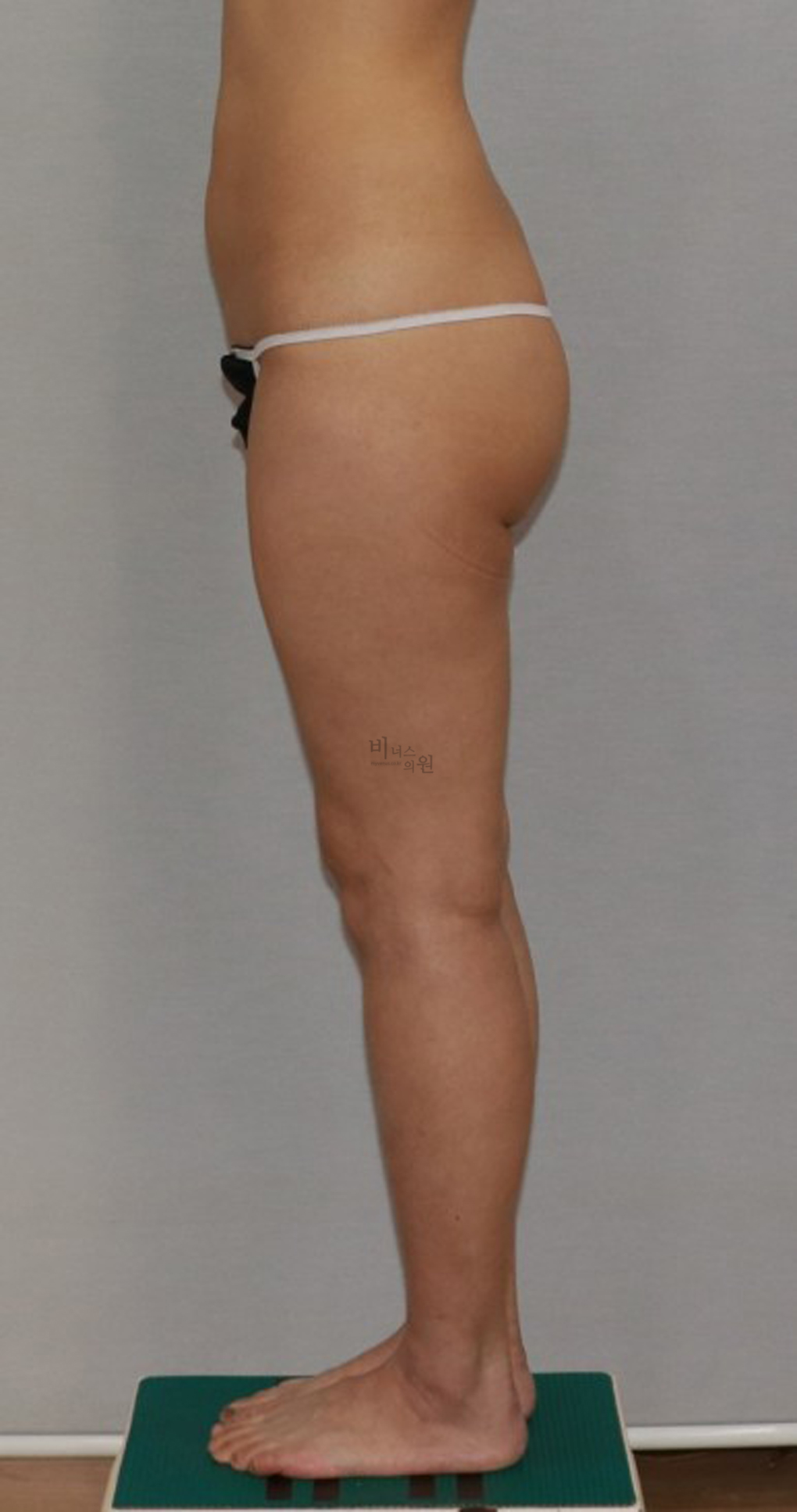 허벅지지방흡입15.jpg