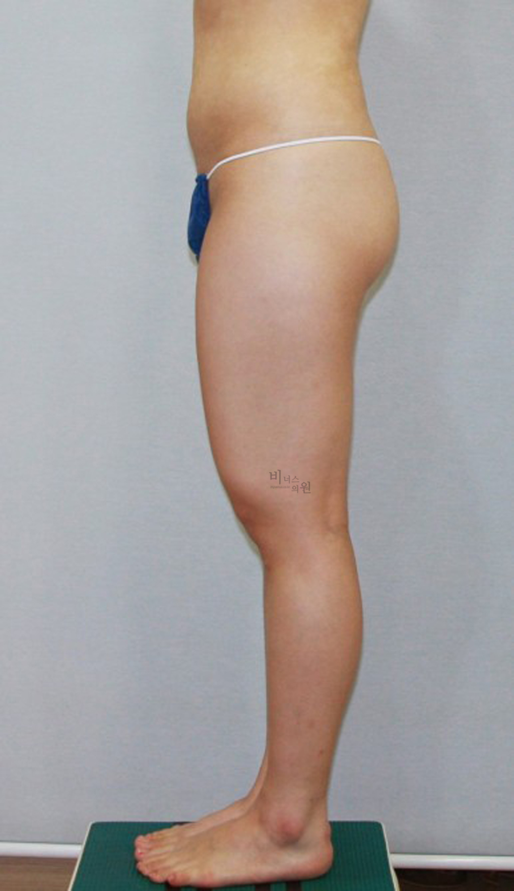 허벅지지방흡입3.jpg