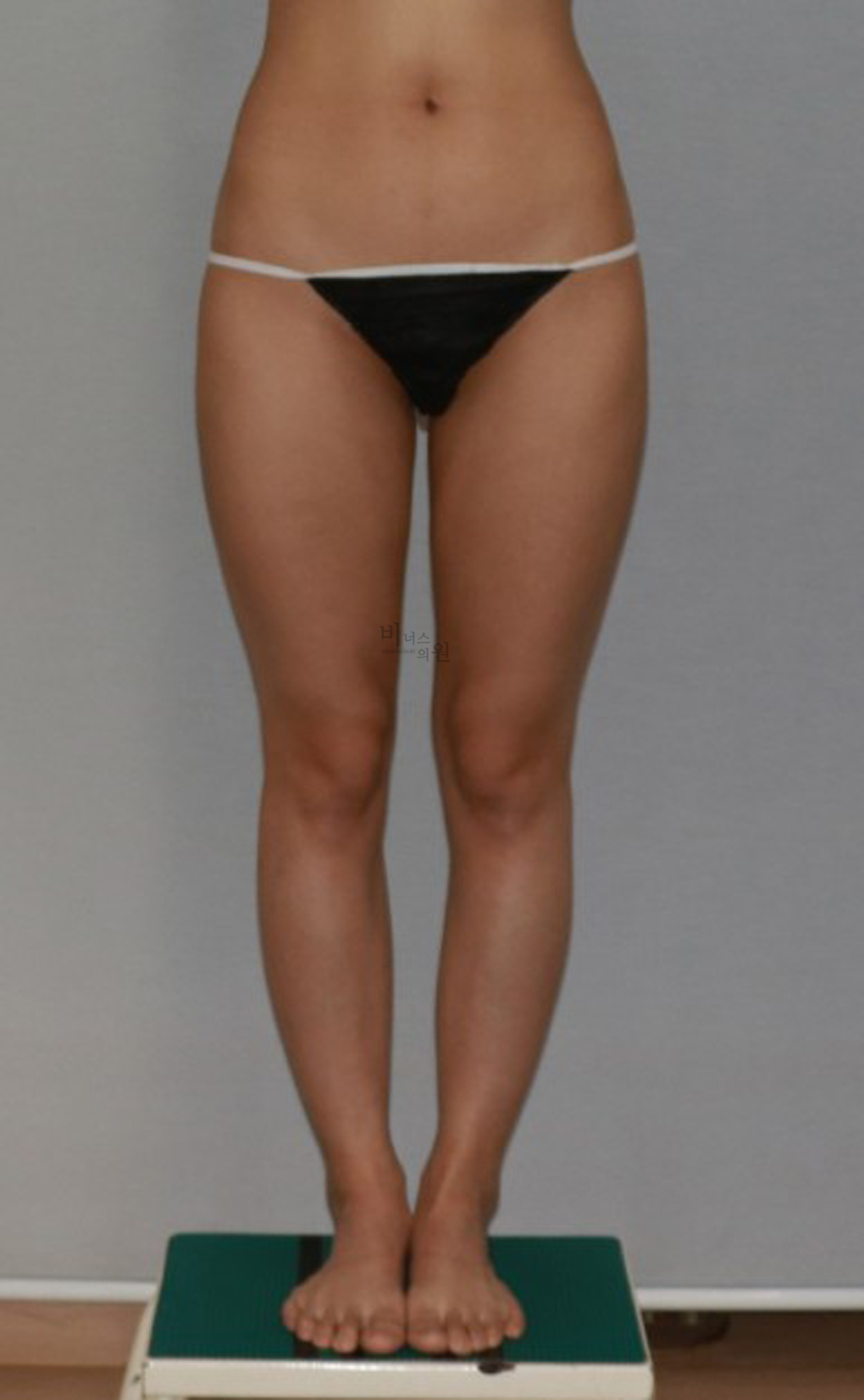 허벅지지방흡입7.jpg