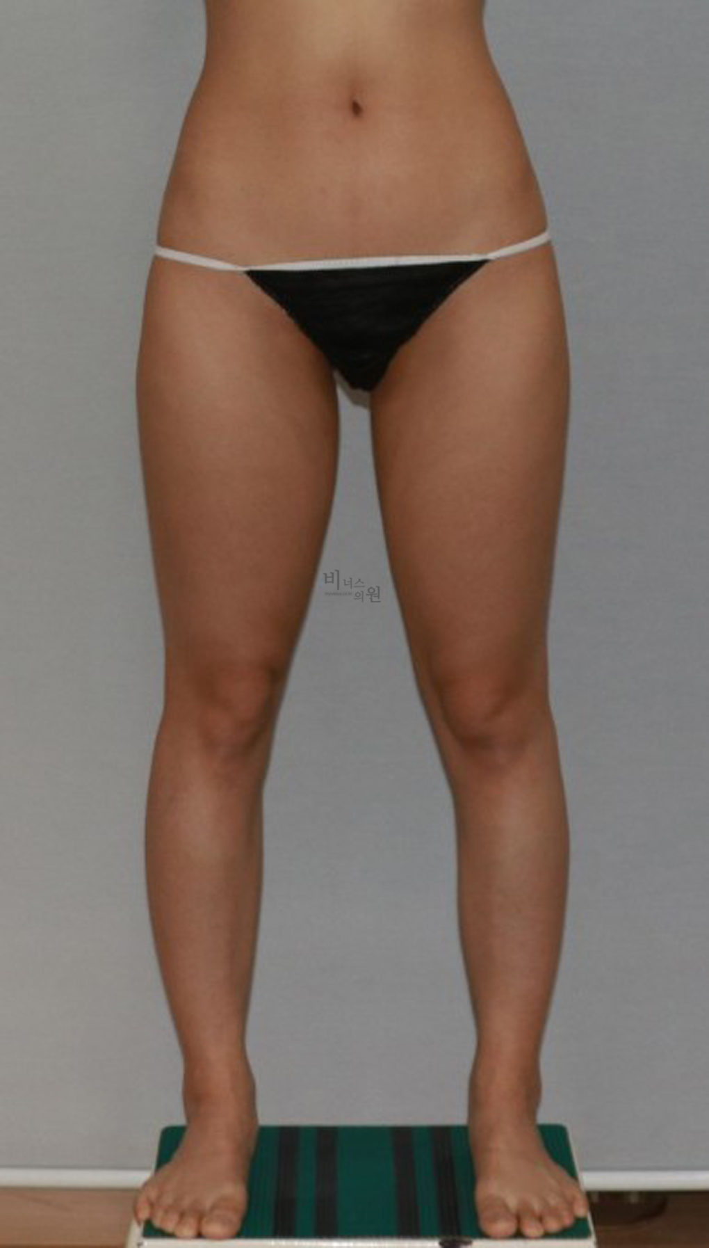 허벅지지방흡입11.jpg