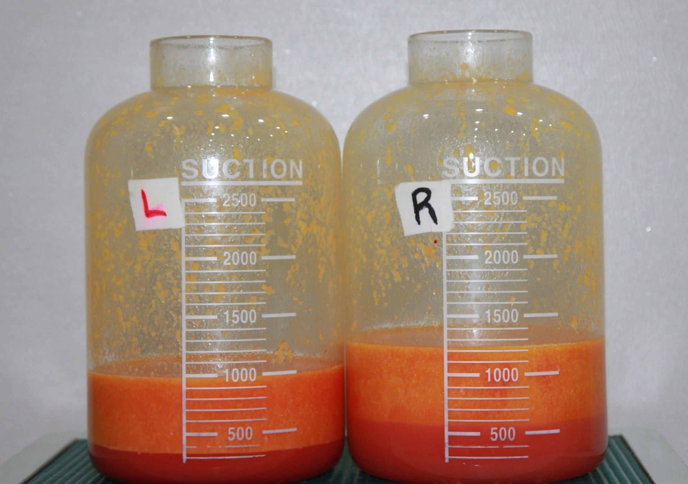 팔 팔뚝 지방흡입 지방량.jpg