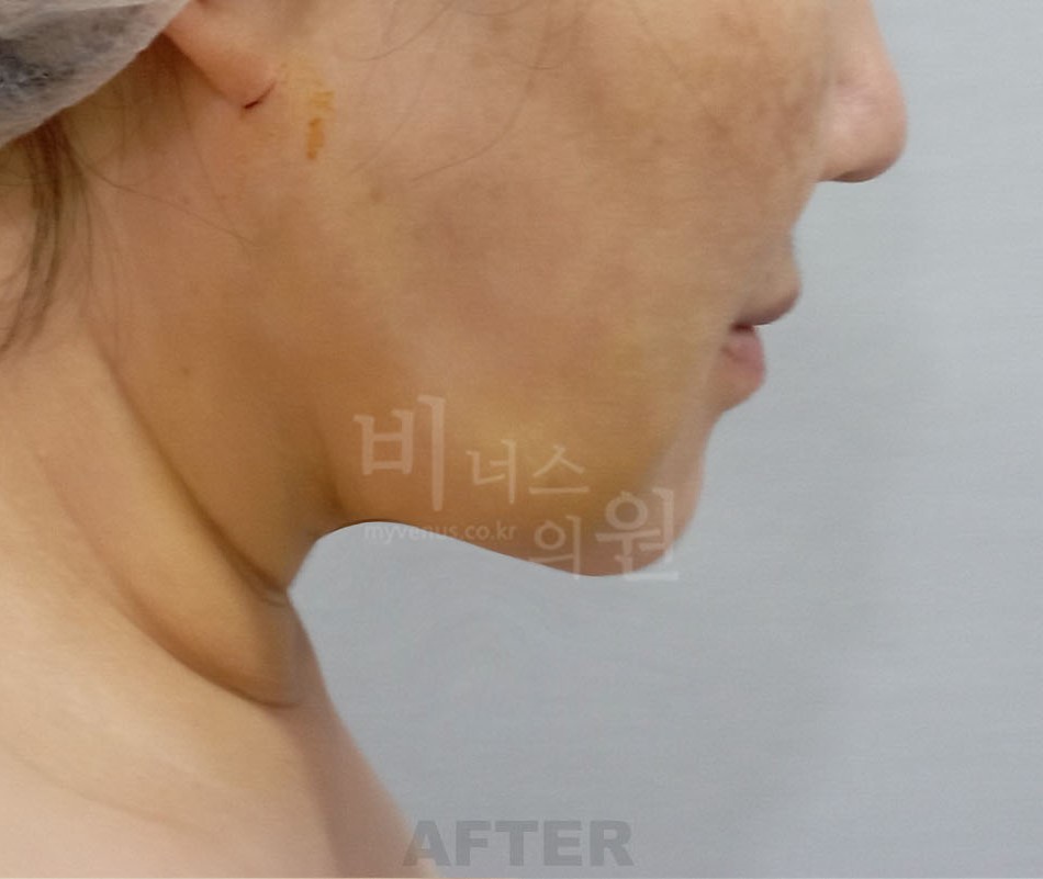 이중턱_얼굴_지방_4.jpg