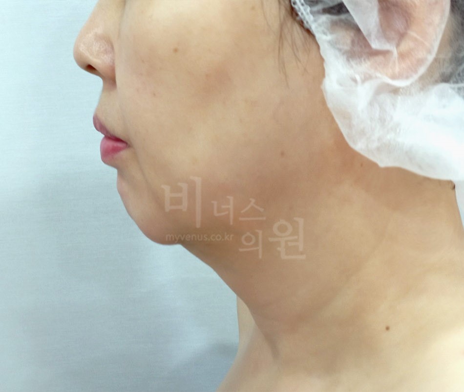 이중턱_목지방흡입_1 - 복사본.jpg