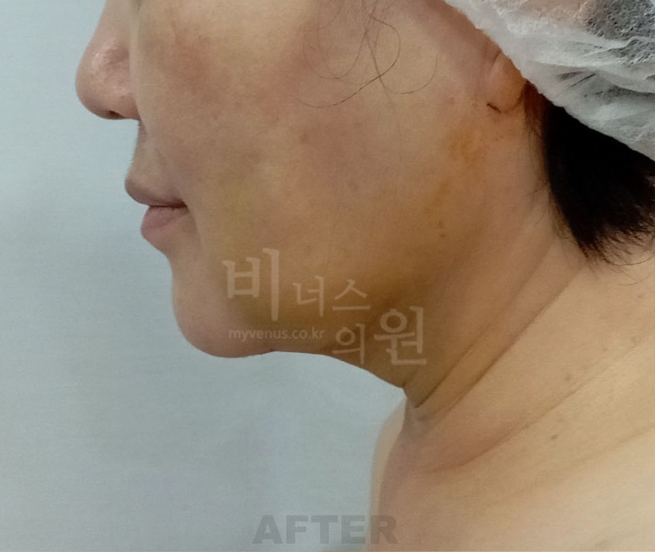 이중턱_얼굴_지방_2.jpg