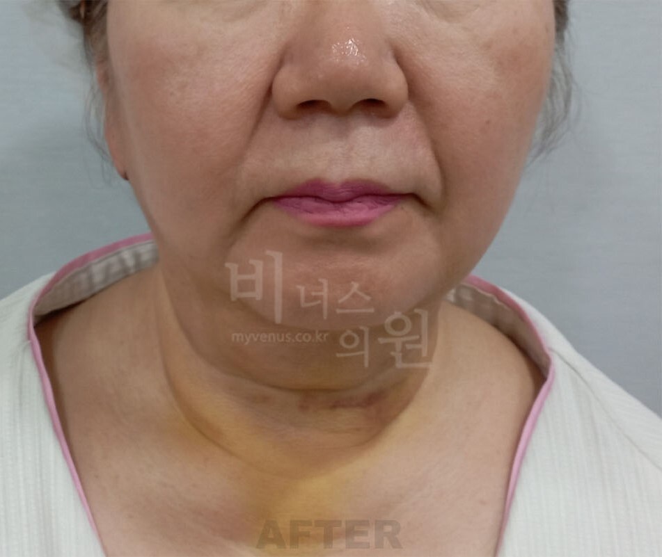 턱 지방흡입 수술 후 정면 사진 - 턱선과 하안면 윤곽 변화 비너스의원