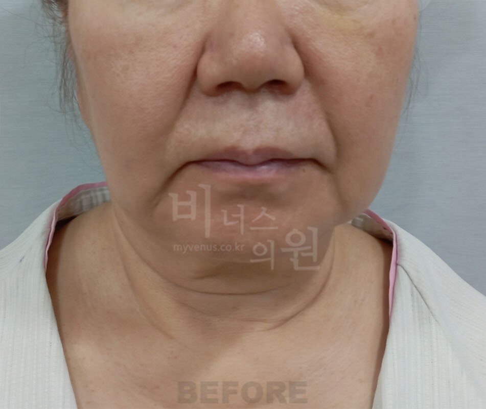 턱 지방흡입 수술 전 정면 사진 - 턱 아래 볼륨과 하안면 윤곽 비너스의원