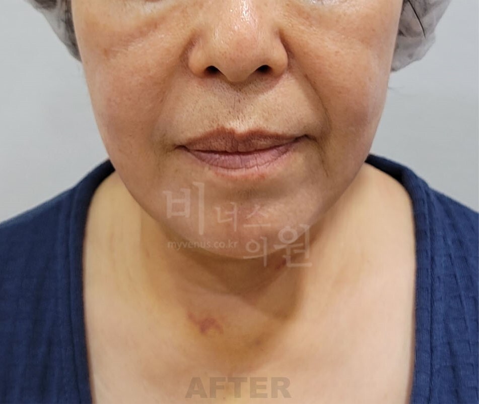 턱 지방흡입 수술 후 정면 사진 - 턱선 변화 비너스의원