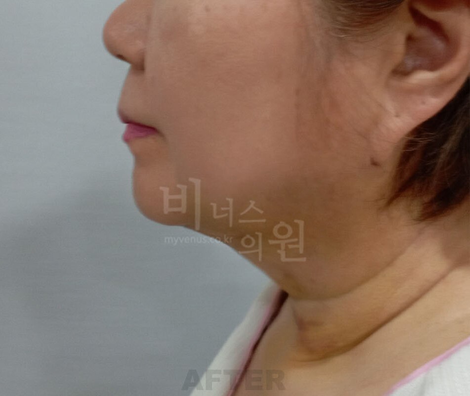 턱 지방흡입 수술 후 측면 사진 - 하악연과 경부 턱밑각 변화 비너스의원