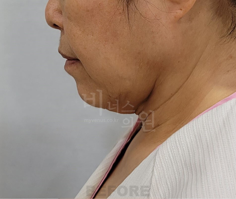 턱 지방흡입 수술 전 측면 사진 - 경부 턱밑각 비너스의원