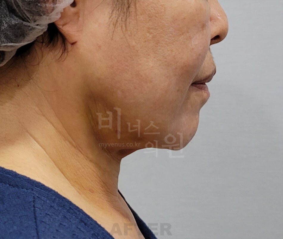 턱 지방흡입 수술 후 반대쪽 측면 사진 - 하악연 변화 비너스의원