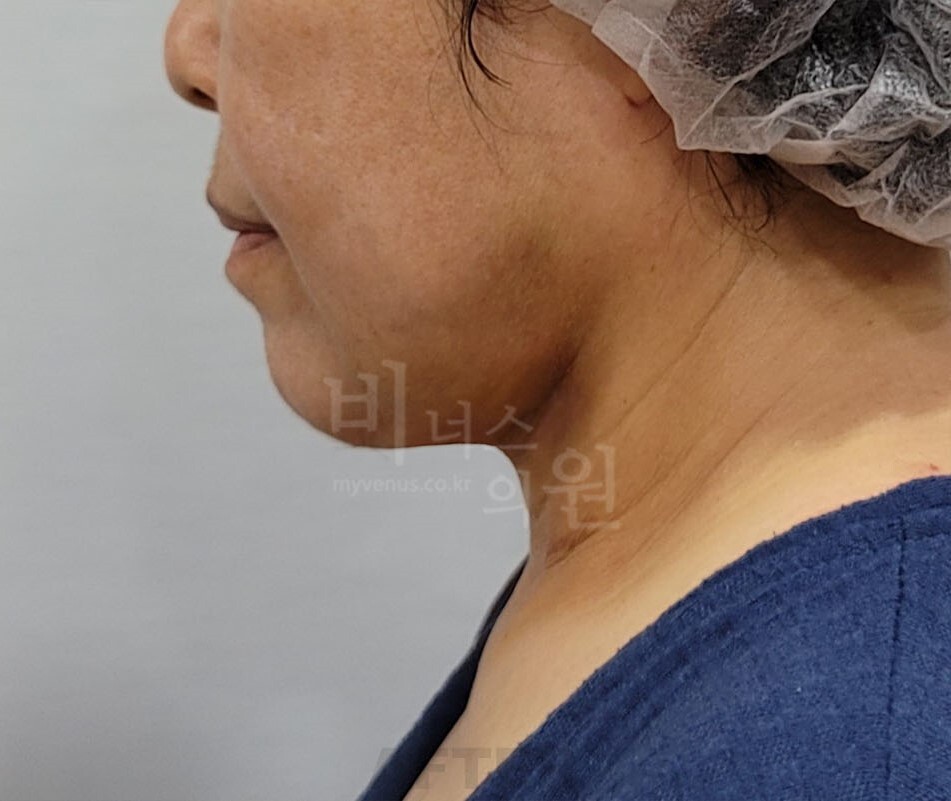 턱 지방흡입 수술 후 측면 사진 - 경부 턱밑각 변화 비너스의원