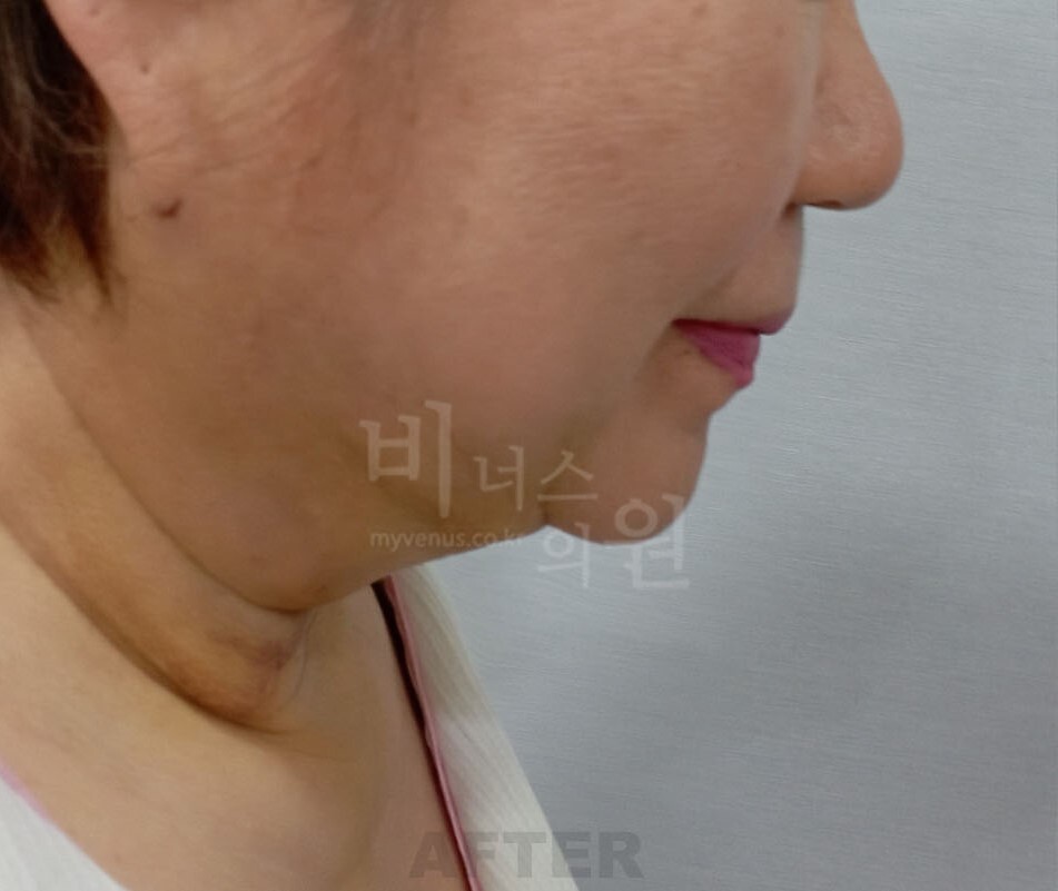 턱 지방흡입 수술 후 반대쪽 측면 사진 - 턱선 변화 비너스의원