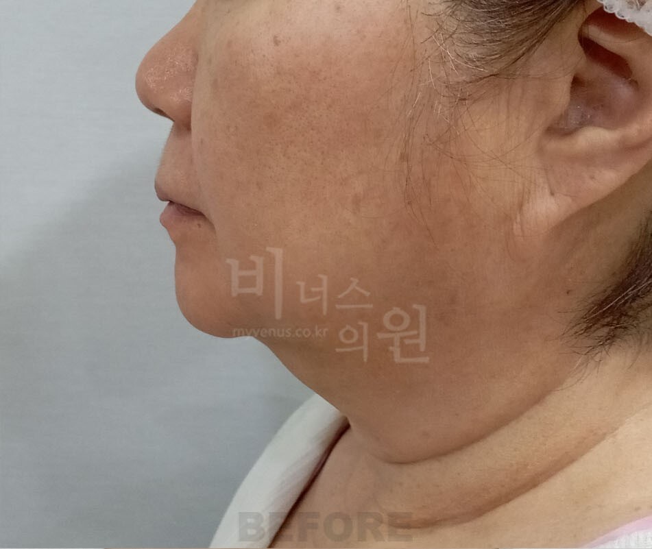 턱 지방흡입 수술 전 측면 사진 - 턱밑 볼륨과 경부 턱밑각 비너스의원