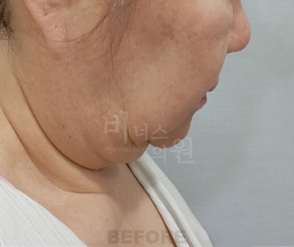 턱 지방흡입 수술 전 반대쪽 측면 사진 - 턱밑 볼륨 비너스의원