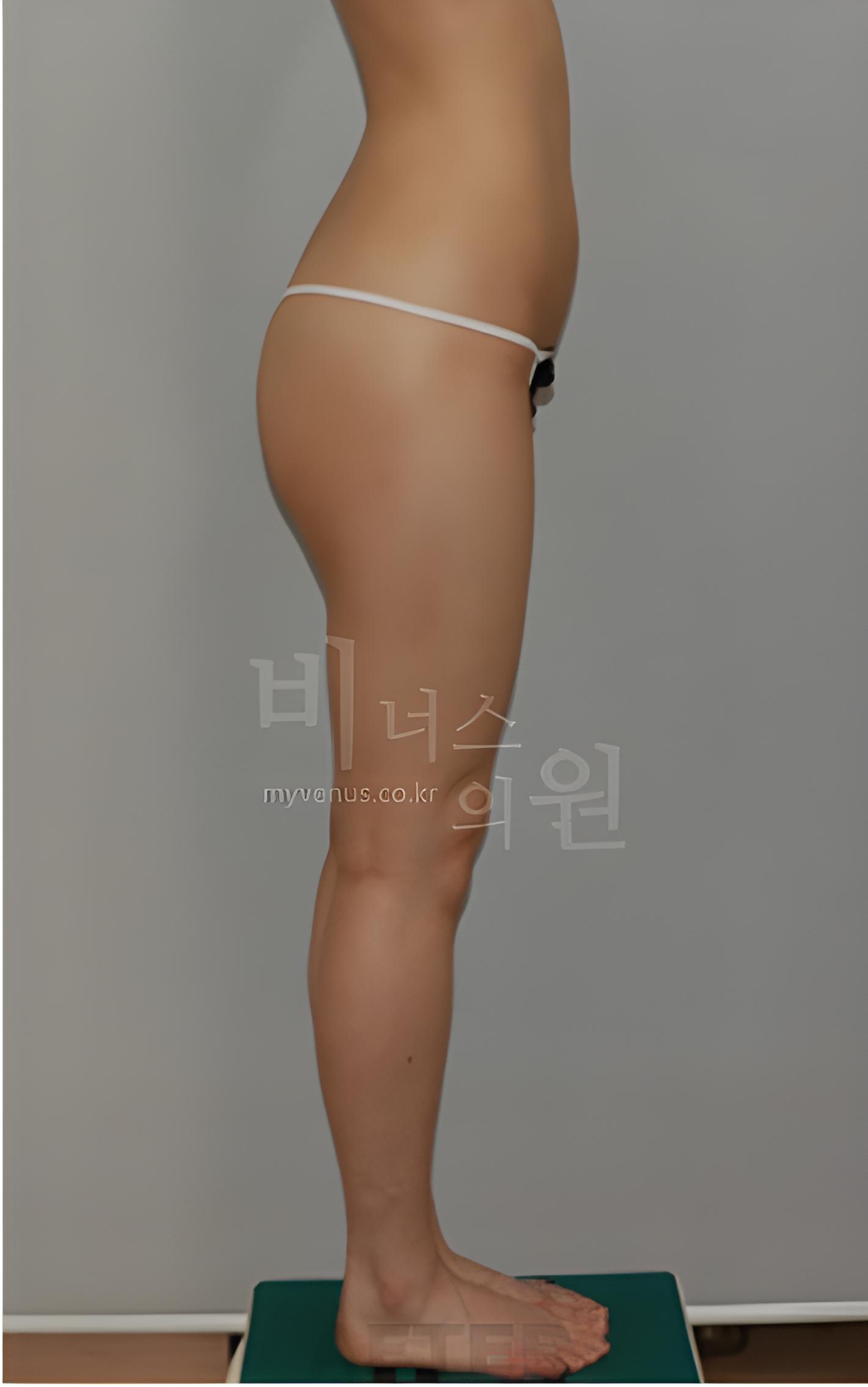 엉덩이 볼륨업 지방흡입 수술 후 측면