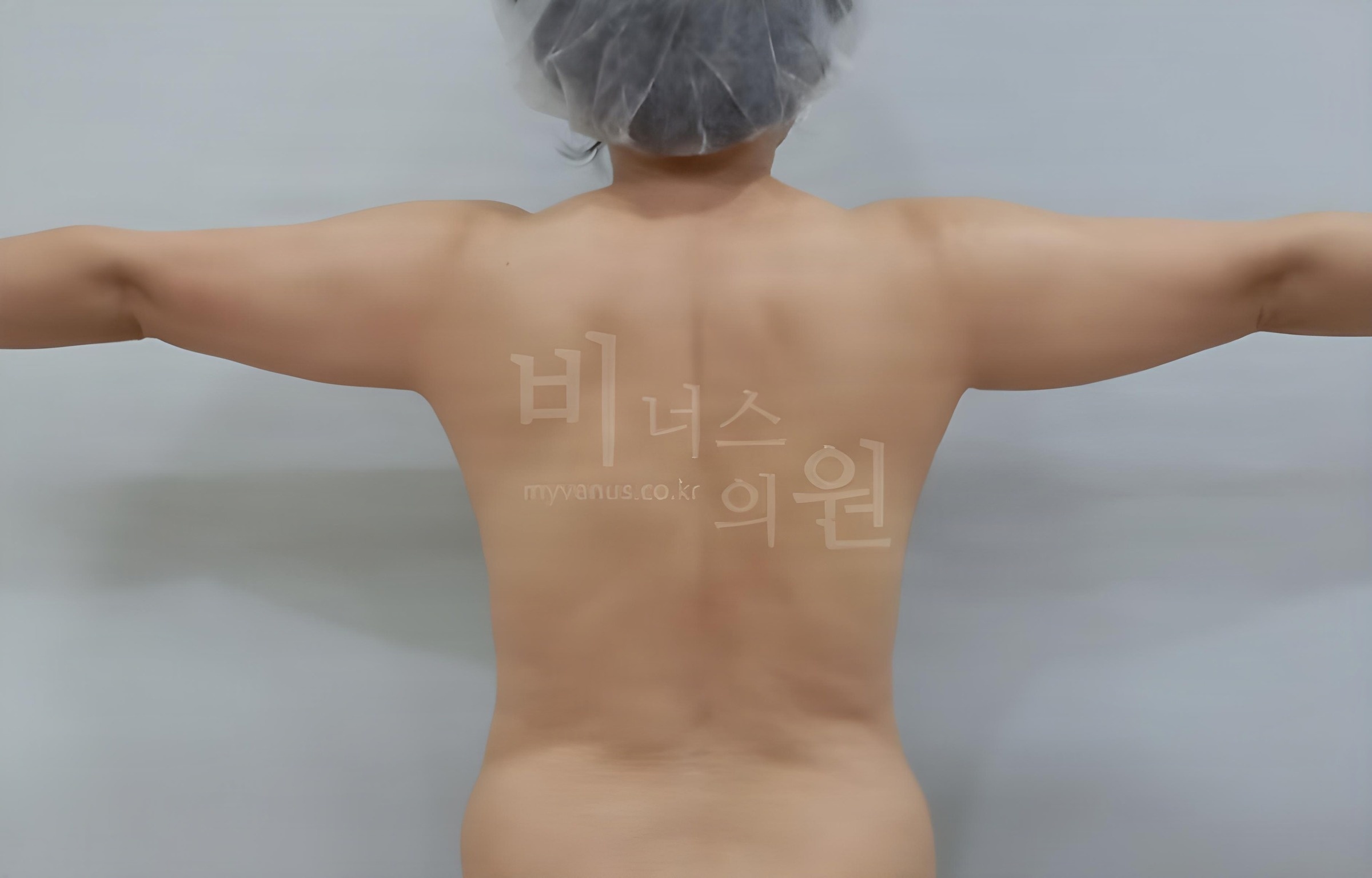 팔뚝 지방흡입 수술 전 후면 팔을 벌린 비너스의원