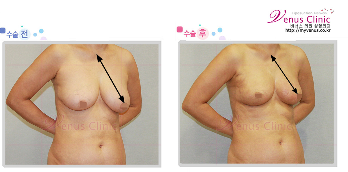 가슴축소1.jpg
