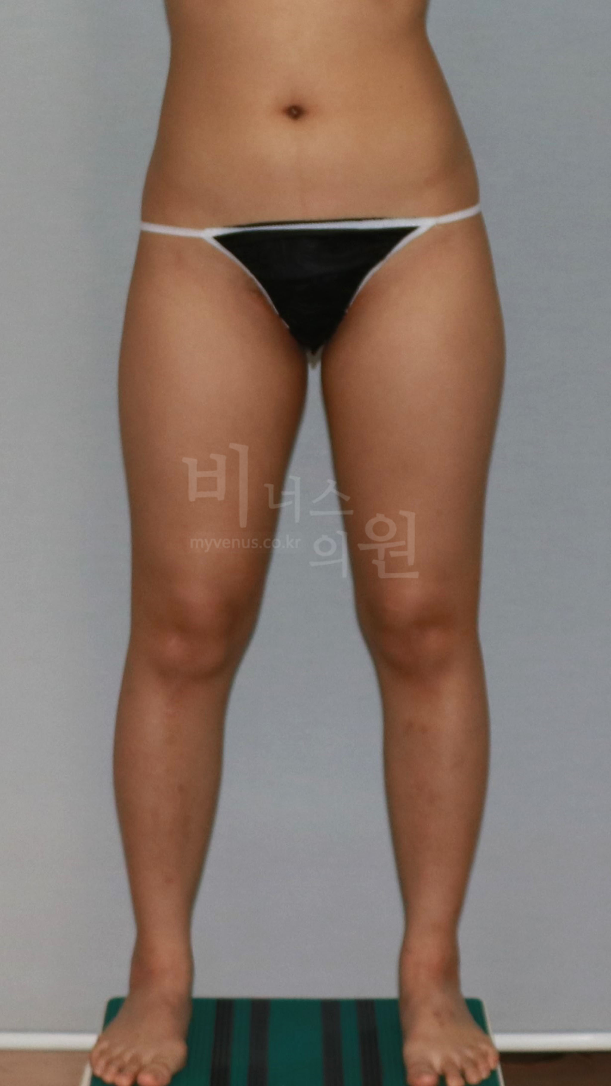 허벅지 안쪽 지방흡입 수술 전 정면 다리벌림 비너스의원