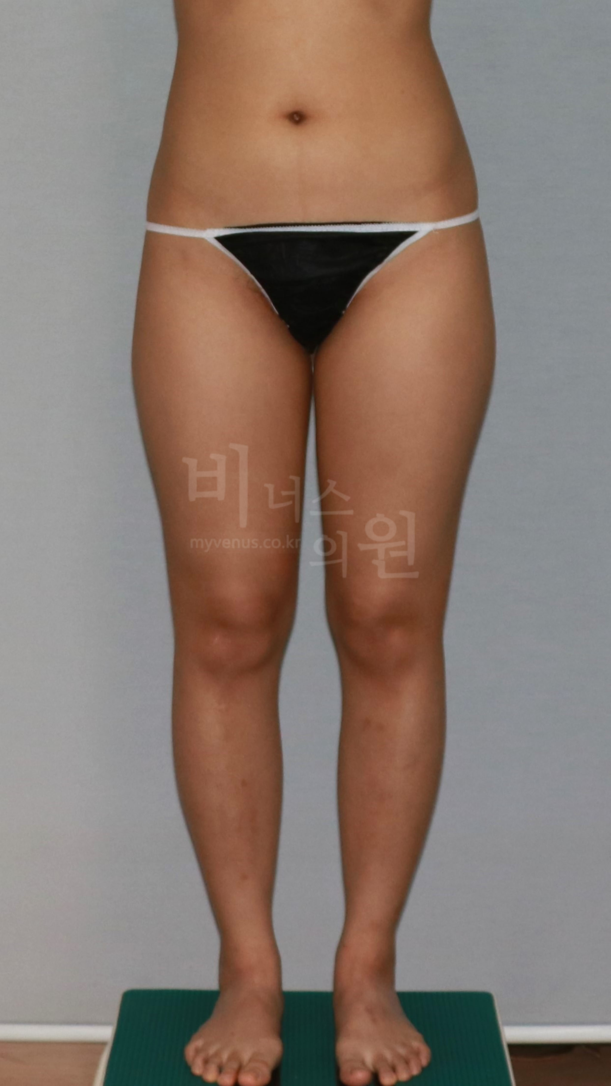 허벅지 안쪽 지방흡입 수술 전 정면 비너스의원