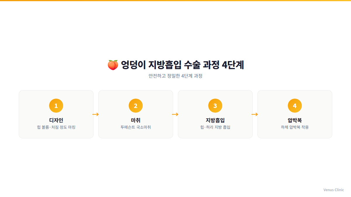 엉덩이 지방흡입 수술 과정 4단계 인포그래픽 — 디자인→마취→지방흡입→압박복
