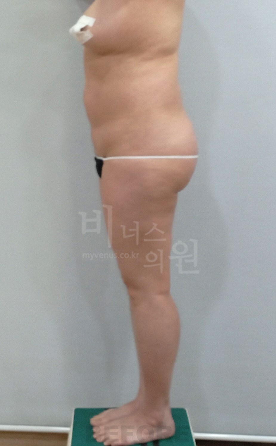 엉덩이 지방흡입 수술 전 측면 비너스의원