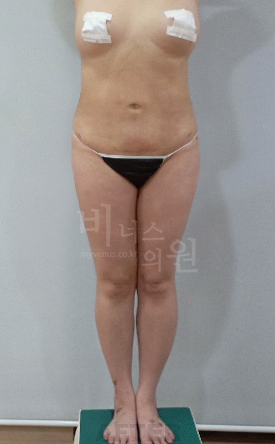 엉덩이 지방흡입 수술 후 정면 비너스의원