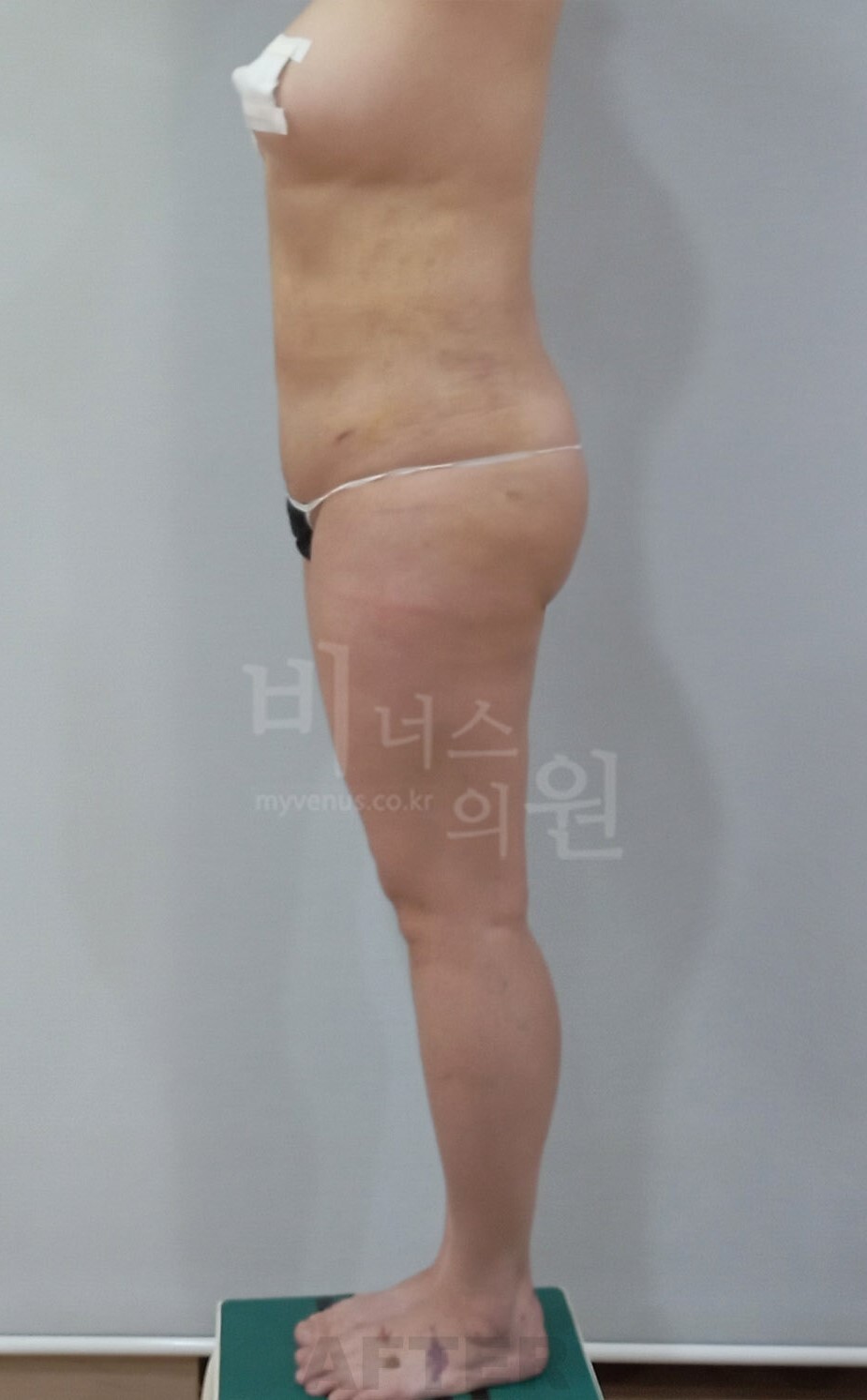 엉덩이 지방흡입 수술 후 측면 비너스의원