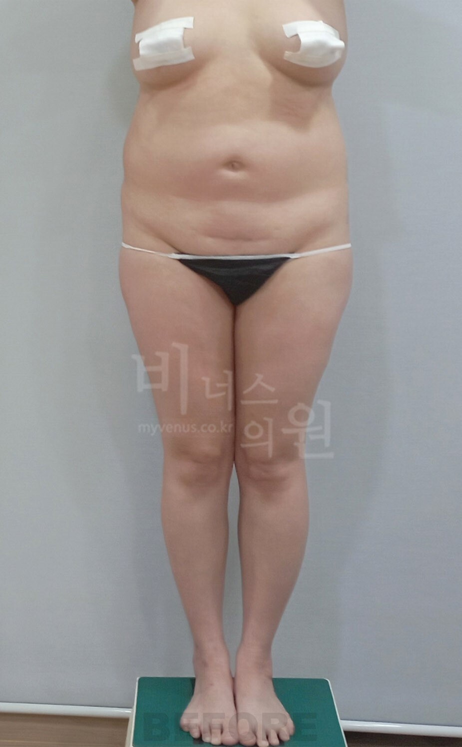 엉덩이 지방흡입 수술 전 정면 비너스의원