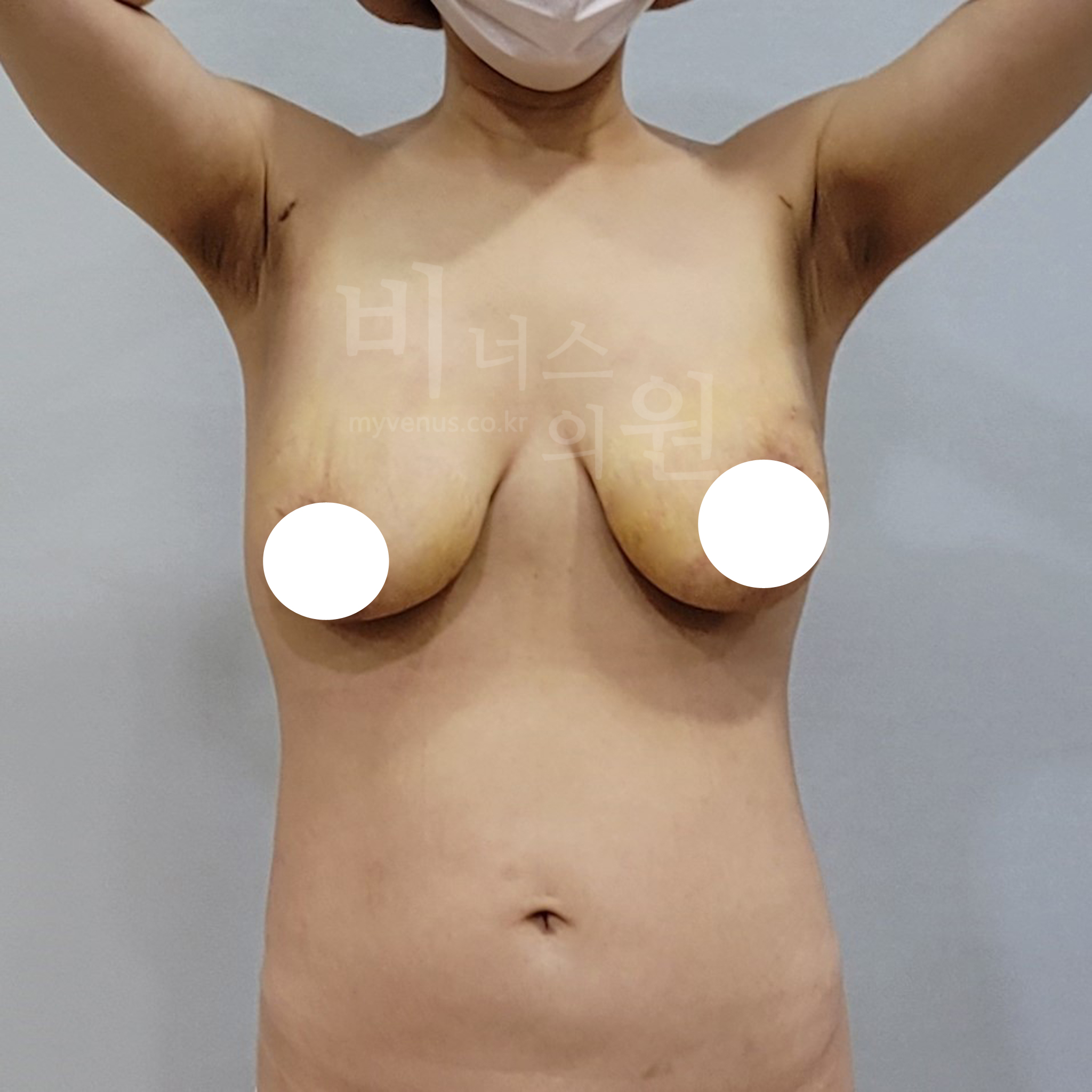 유방 가슴축소 지방흡입 수술 후 1주 정면 사진