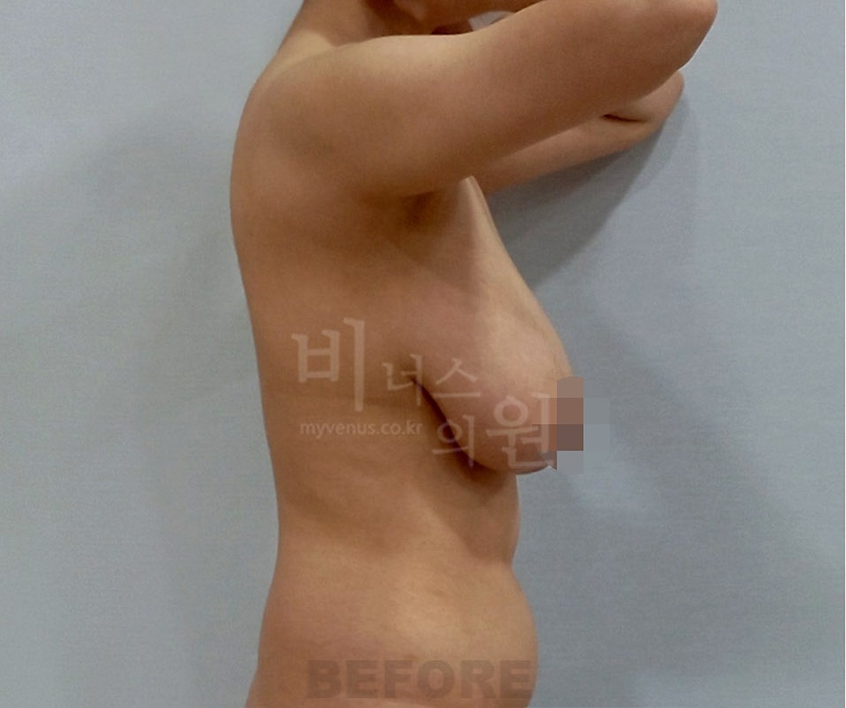 유방하수 지방흡입 수술 전 측면 팔 올림 유방 아래쪽이 앞과 아래로 늘어진 모습 비너스의원