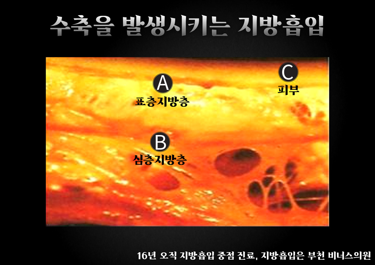 수축지흡-003 (1).jpg