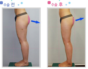 엉덩이지방흡입3_3.jpg