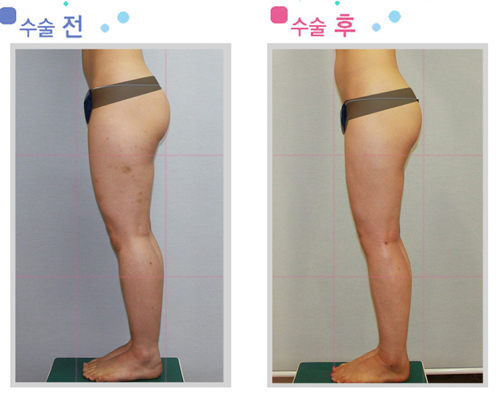 엉덩이지방흡입2.jpg