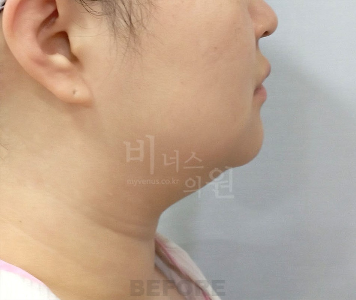 이중턱 턱 목 지방흡입 수술 전 반대쪽 측면 비너스의원