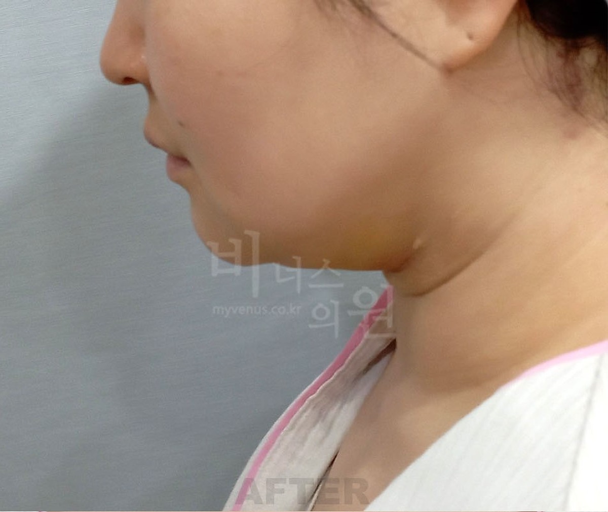 이중턱 턱 목 지방흡입 수술 후 측면 비너스의원