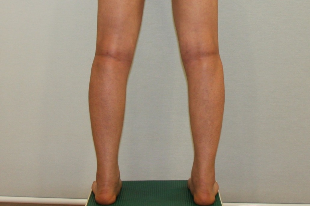 종아리 지방흡입 종아리 알제거 종아리주사 종아리살빼기 종아리 수술전후 4주 경과 후기 당일.JPG