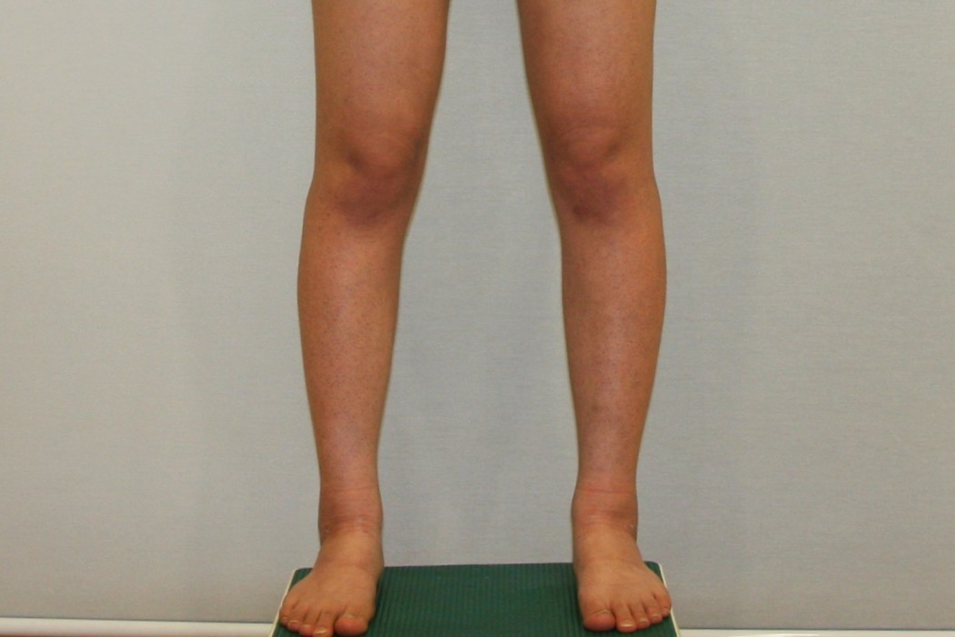 종아리 지방흡입 종아리알통 종아리주사 종아리살빼기 종아리지흡 종아리수술전후 후기 경과 당일 1주 4주 멍 부기 후기.JPG