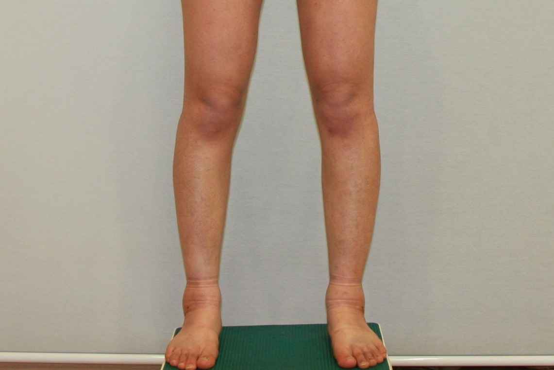 종아리 지방흡입 종아리알통 종아리주사 종아리살빼기 종아리지흡 종아리수술전후 후기 경과 당일 1주일 멍 부기 후기.JPG