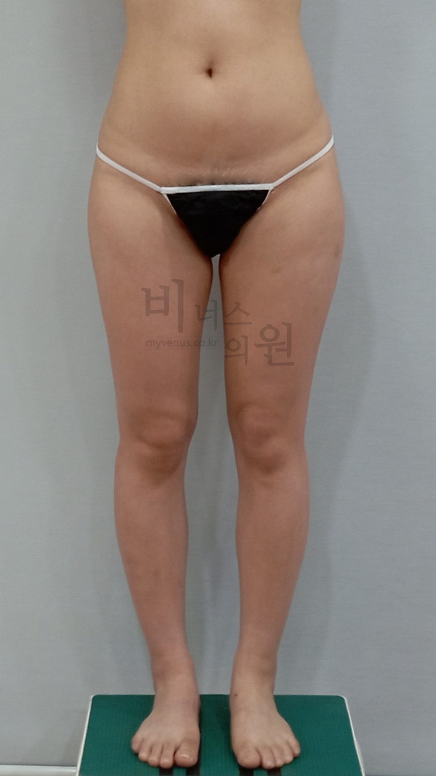 엉덩이축소 지방흡입 수술 전 정면 비너스의원