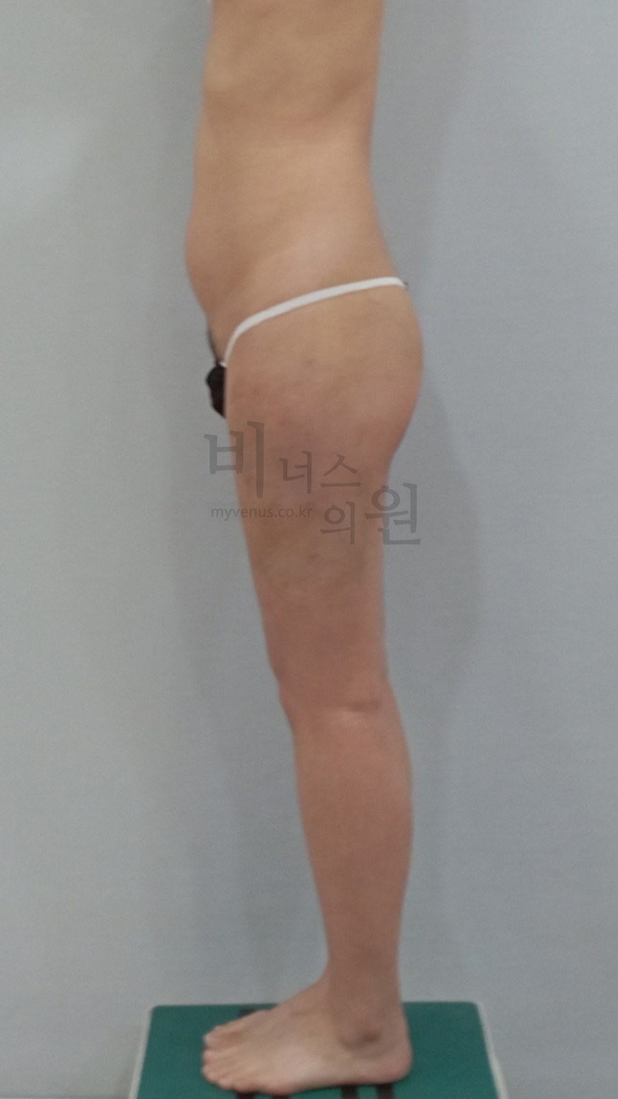 엉덩이축소 지방흡입 수술 후 우측면 비너스의원