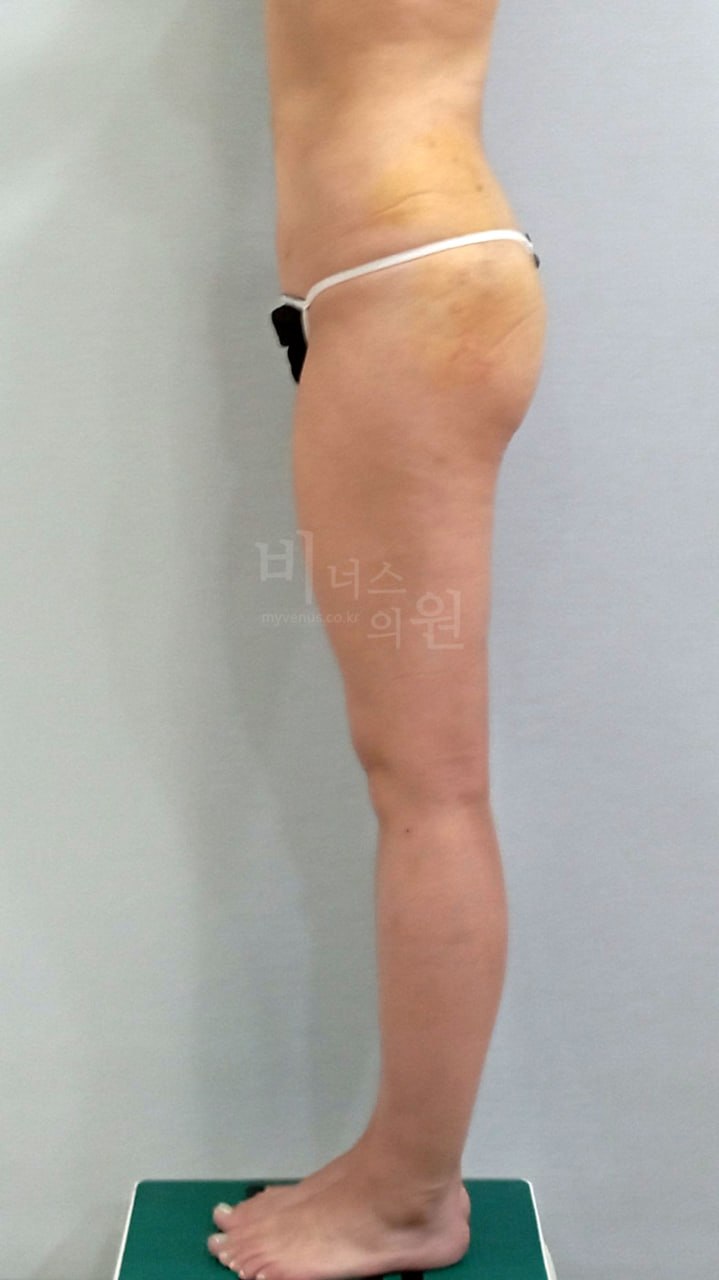엉덩이 볼륨업 지방흡입 수술 후 우측면 비너스의원