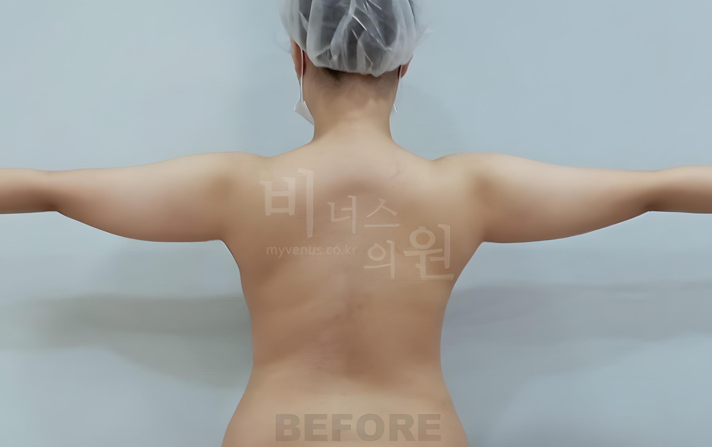 팔뚝 지방흡입 수술 전 후면 팔 벌리기 비너스의원