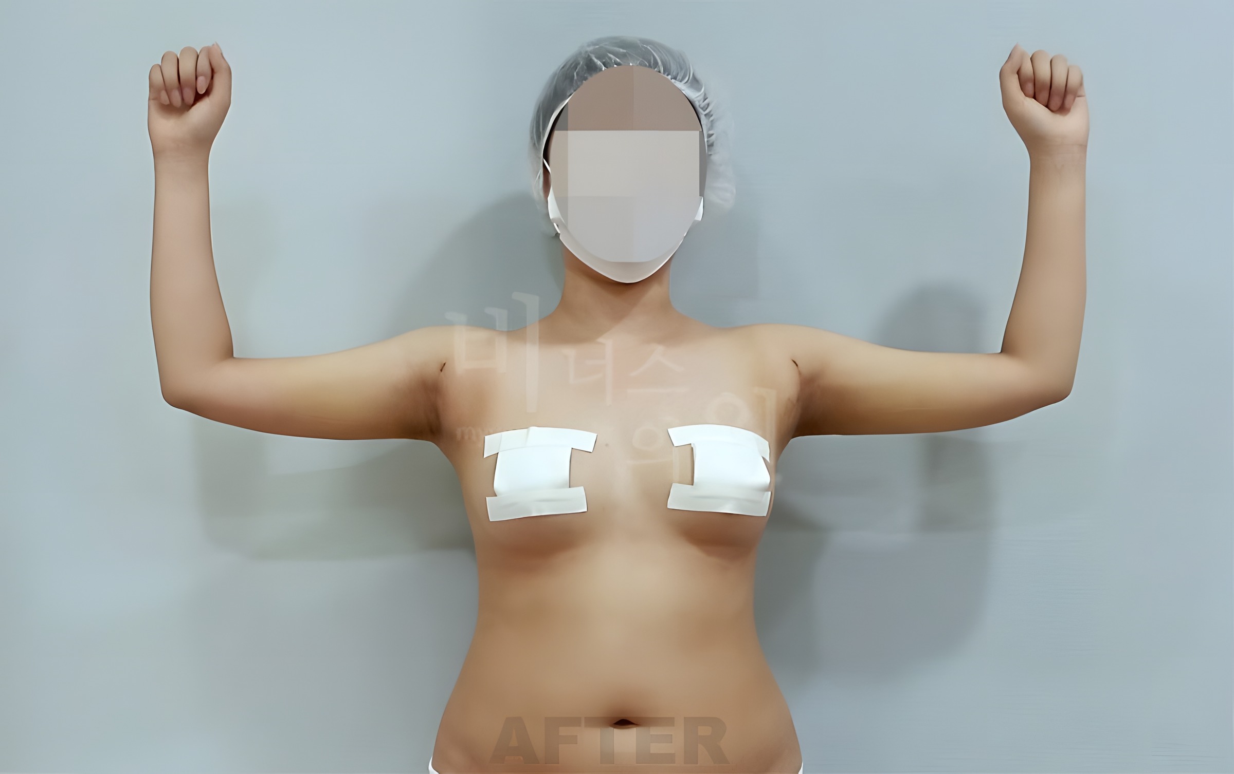 팔뚝 지방흡입 수술 후 정면 팔 위로 들기 비너스의원