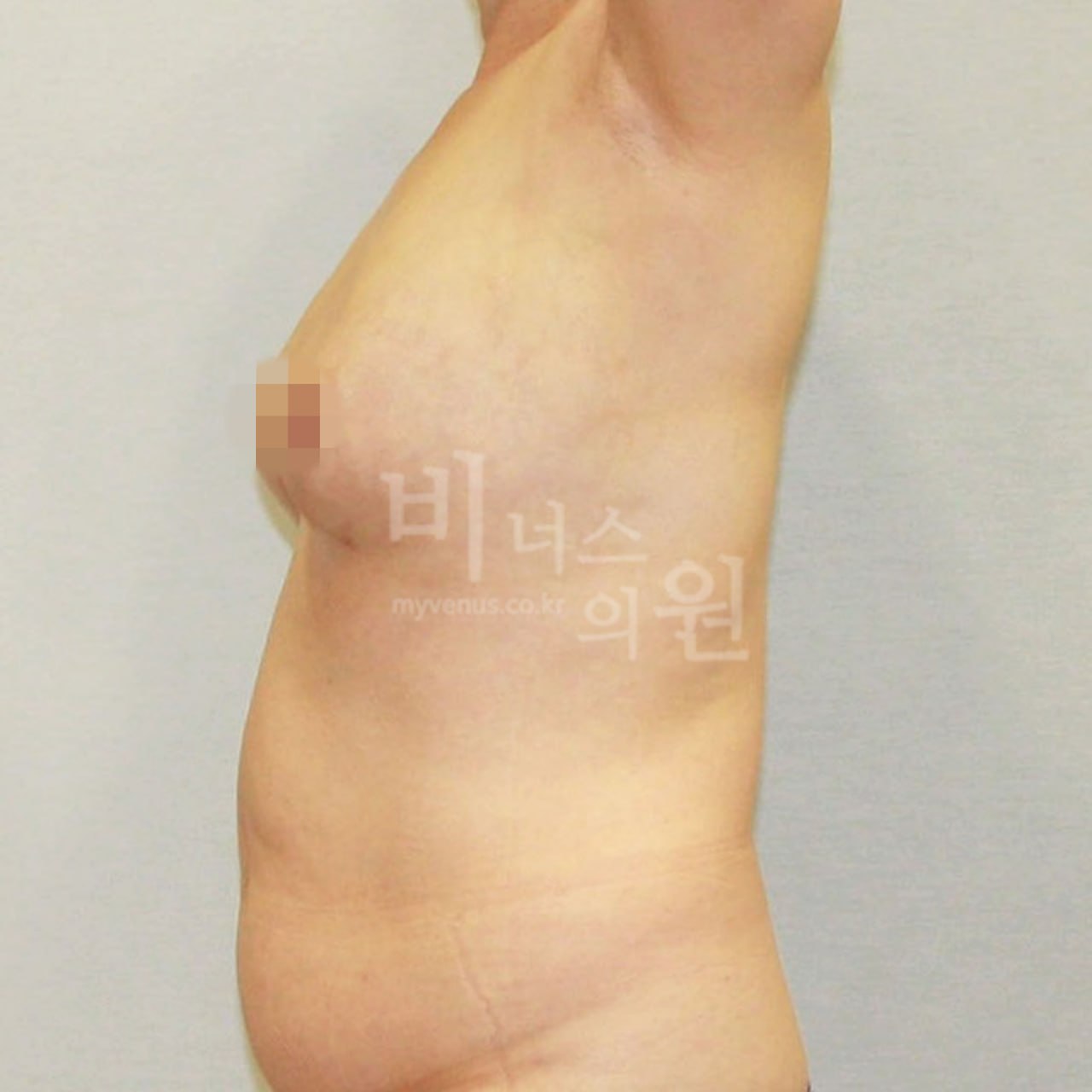 가슴축소 지방흡입 수술 후 측면 비너스의원