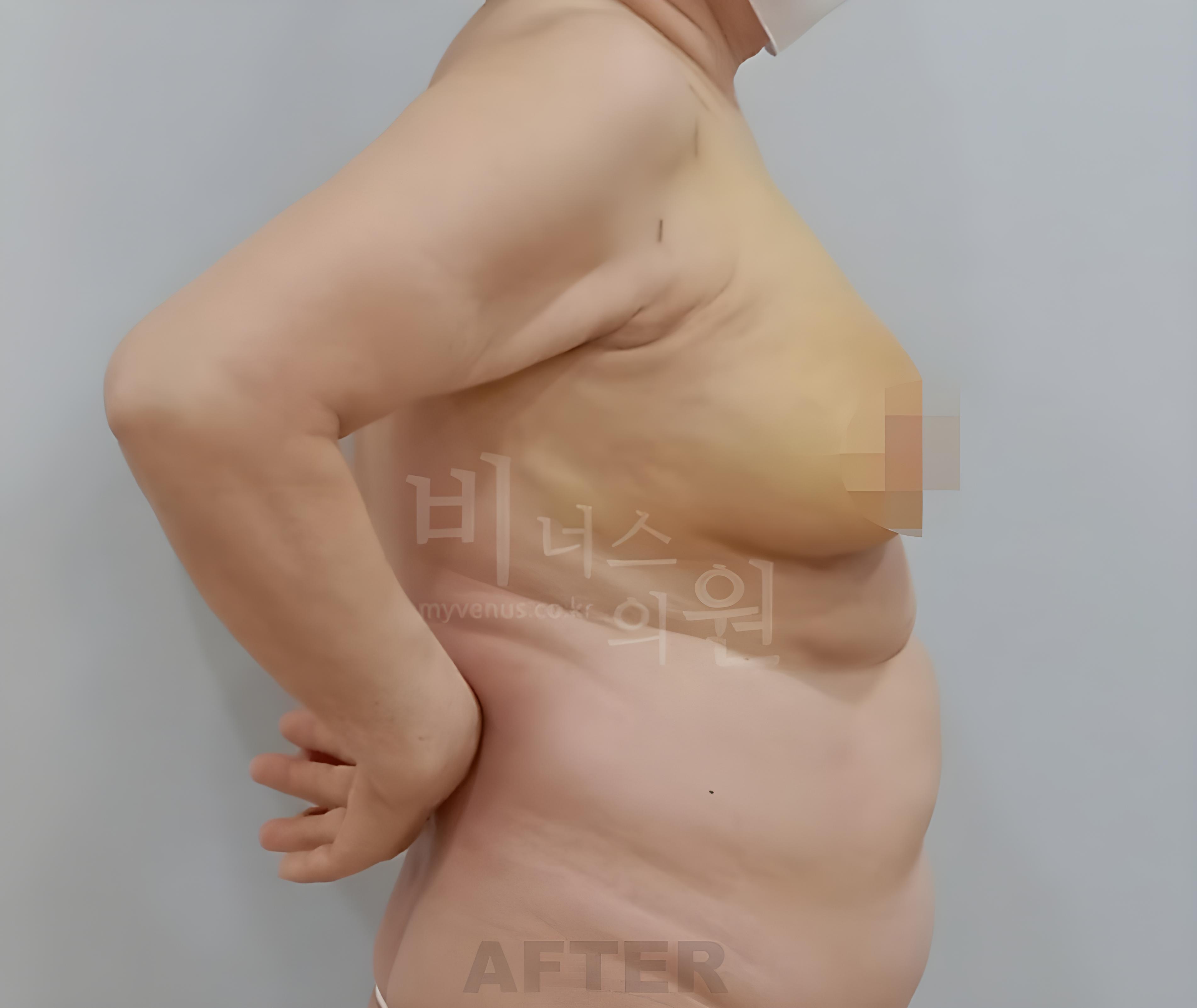 유방 표층 지방흡입 수술 후 측면 비너스의원