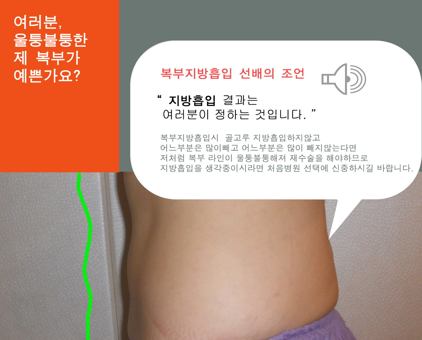 지방흡입 (200).jpg