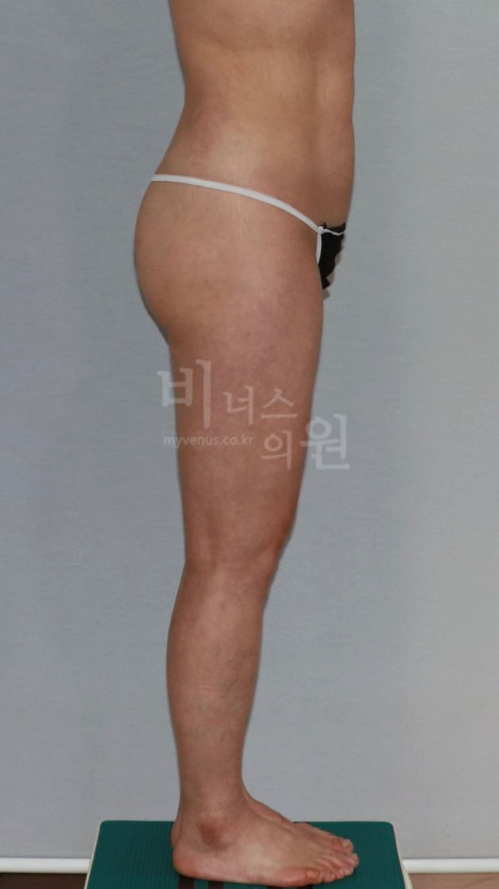 엉덩이 지방흡입(이중주름 볼륨이식 병행) 수술 후 1주 왼측면 사진